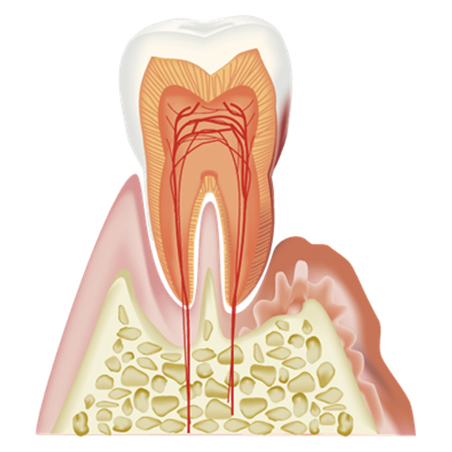 歯周病の急性期
