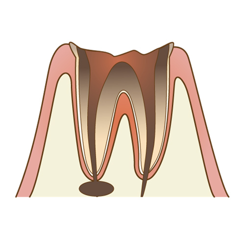重度虫歯（C4:感染根管）